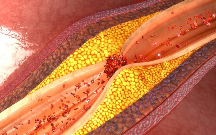 These Daily Aches and Pains Could Mean Clogged Arteries