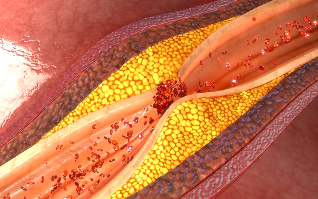 These-Daily-Aches-and-Pains-Could-Mean-Clogged-Arteries These Daily Aches and Pains Could Mean Clogged Arteries