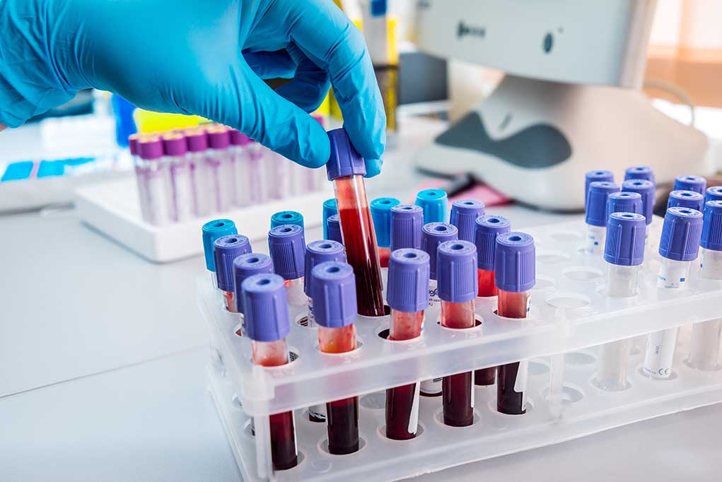 327930536 featured image Gloved hand handling blood samples in a laboratory.