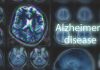 Urgent WARNING — Brain Pollution Crisis Uncovered MRI brain scan highlighting Alzheimer's disease