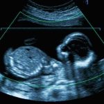 Oldest Embryo? Not The Wildest Part Fetal ultrasound scan image